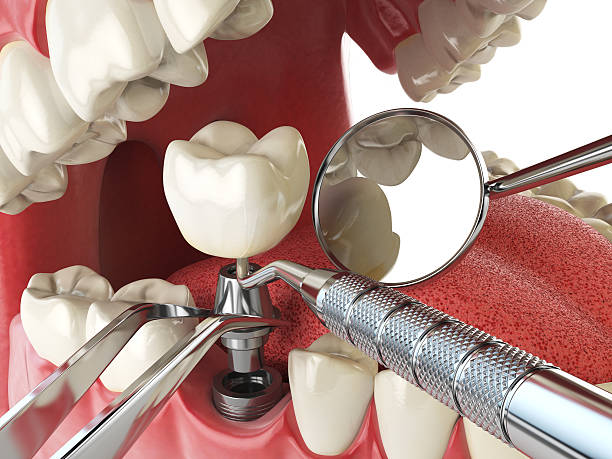 Best Emergency Treatment for Dental Infections or Abscesses in Grayson, KY